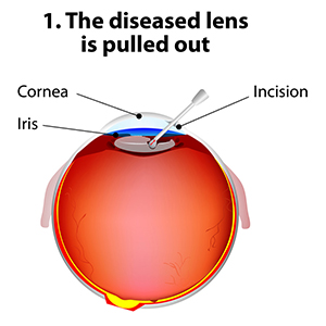 cataract surgery 01