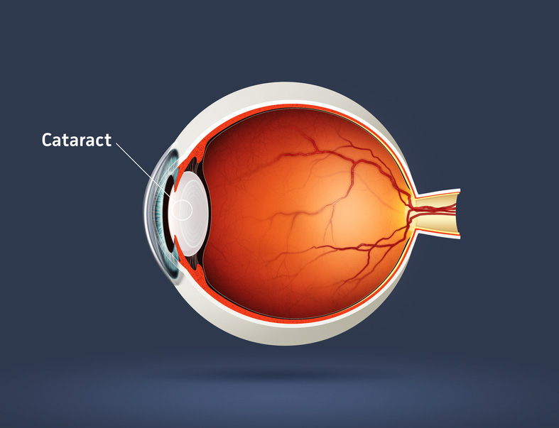 cataract article